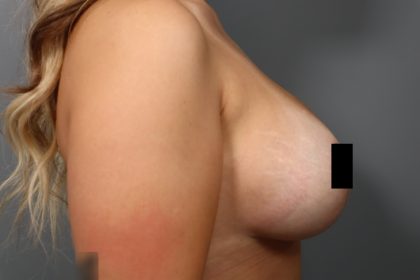 Breast Lift Before & After Patient #3187