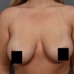Breast Lift Before & After Patient #3187
