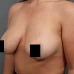 Breast Lift Before & After Patient #3187