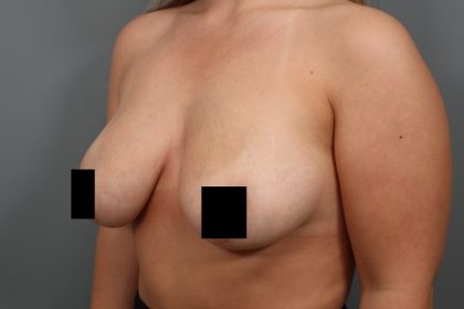 Breast Lift Before & After Patient #3187