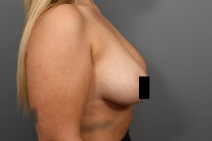 Breast Lift Before & After Patient #3187