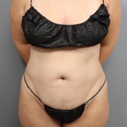 Tummy Tuck Before & After Patient #3268
