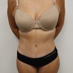 Tummy Tuck Before & After Patient #3268