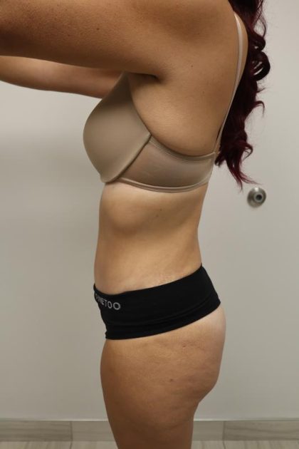 Tummy Tuck Before & After Patient #3268
