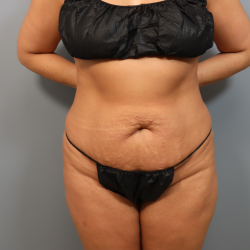 Tummy Tuck Before & After Patient #3418
