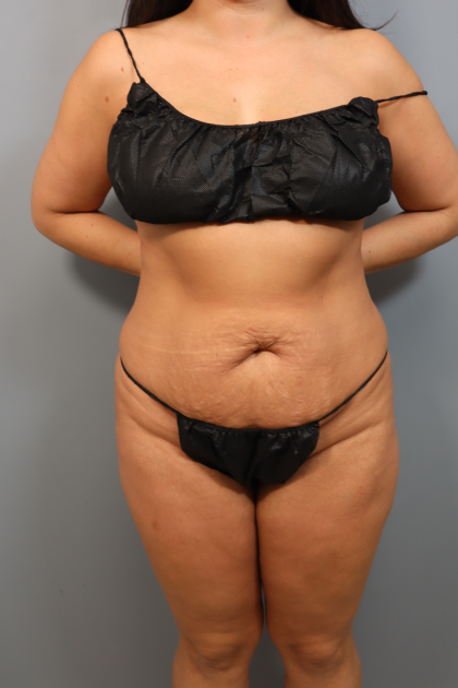 Tummy Tuck Before & After Patient #3418