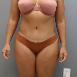 Tummy Tuck Before & After Patient #3418