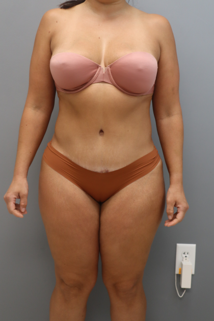 Tummy Tuck Before & After Patient #3418