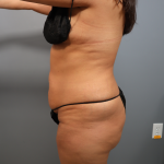 Tummy Tuck Before & After Patient #3418