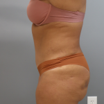 Tummy Tuck Before & After Patient #3418
