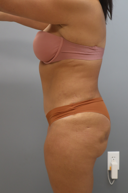 Tummy Tuck Before & After Patient #3418