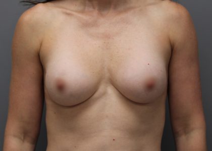 Motiva Preserve Breast Augmentation Before & After Patient #3583