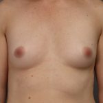 Motiva Preserve Breast Augmentation Before & After Patient #3582