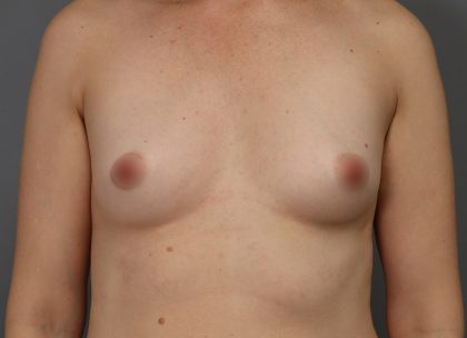 Motiva Preserve Breast Augmentation Before & After Patient #3582