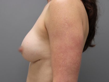 Motiva Preserve Breast Augmentation Before & After Patient #3583