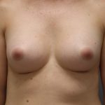 Motiva Preserve Breast Augmentation Before & After Patient #3582