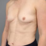 Motiva Preserve Breast Augmentation Before & After Patient #3583
