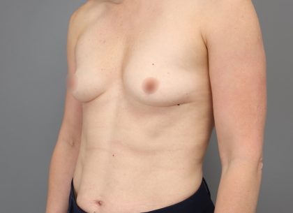 Motiva Preserve Breast Augmentation Before & After Patient #3583