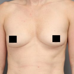 Motiva Preserve Breast Augmentation Before & After Patient #3583