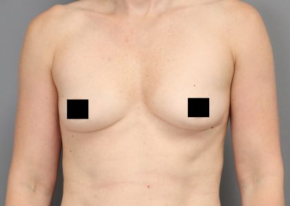 Motiva Preserve Breast Augmentation Before & After Patient #3583