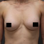 Motiva Preserve Breast Augmentation Before & After Patient #3583