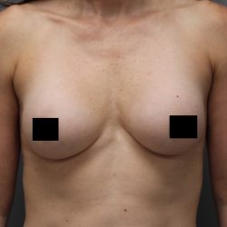 Motiva Preserve Breast Augmentation Before & After Patient #3583