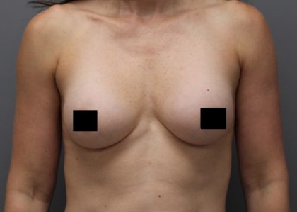 Motiva Preserve Breast Augmentation Before & After Patient #3583