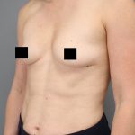 Motiva Preserve Breast Augmentation Before & After Patient #3583