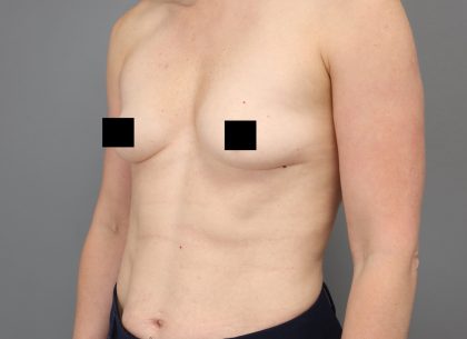 Motiva Preserve Breast Augmentation Before & After Patient #3583
