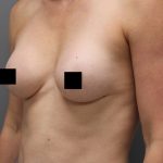 Motiva Preserve Breast Augmentation Before & After Patient #3583