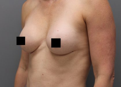 Motiva Preserve Breast Augmentation Before & After Patient #3583