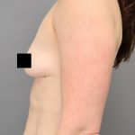 Motiva Preserve Breast Augmentation Before & After Patient #3583