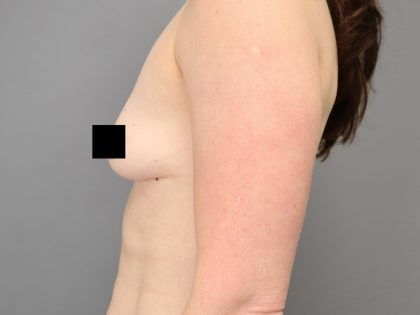 Motiva Preserve Breast Augmentation Before & After Patient #3583