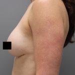 Motiva Preserve Breast Augmentation Before & After Patient #3583