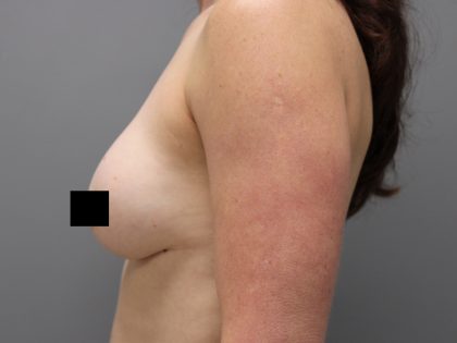 Motiva Preserve Breast Augmentation Before & After Patient #3583