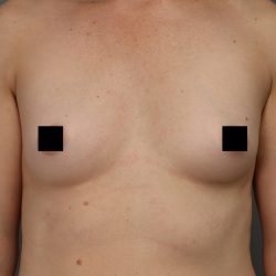 Motiva Preserve Breast Augmentation Before & After Patient #3582
