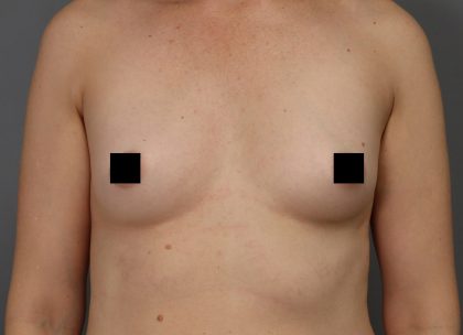 Motiva Preserve Breast Augmentation Before & After Patient #3582