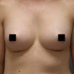 Motiva Preserve Breast Augmentation Before & After Patient #3582