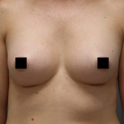 Motiva Preserve Breast Augmentation Before & After Patient #3582