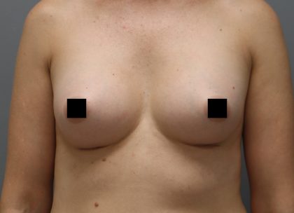 Motiva Preserve Breast Augmentation Before & After Patient #3582
