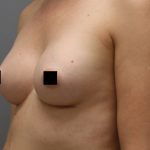 Motiva Preserve Breast Augmentation Before & After Patient #3582