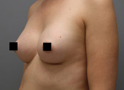 Motiva Preserve Breast Augmentation Before & After Patient #3582