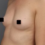 Motiva Preserve Breast Augmentation Before & After Patient #3582