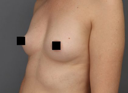 Motiva Preserve Breast Augmentation Before & After Patient #3582