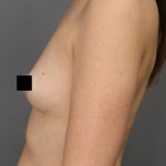 Motiva Preserve Breast Augmentation Before & After Patient #3582