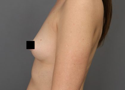Motiva Preserve Breast Augmentation Before & After Patient #3582