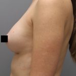 Motiva Preserve Breast Augmentation Before & After Patient #3582