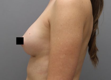 Motiva Preserve Breast Augmentation Before & After Patient #3582
